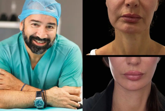 V-LIFT του Dr. Ανδρεανίδη: Μια σύγχρονη προσέγγιση στην ανανέωση του προσώπου Photo Collage Maker_2026_09_08_07_05_07