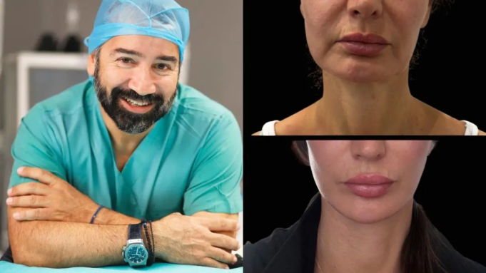 V-LIFT του Dr. Ανδρεανίδη: Μια σύγχρονη προσέγγιση στην ανανέωση του προσώπου Photo Collage Maker_2026_09_08_07_05_07